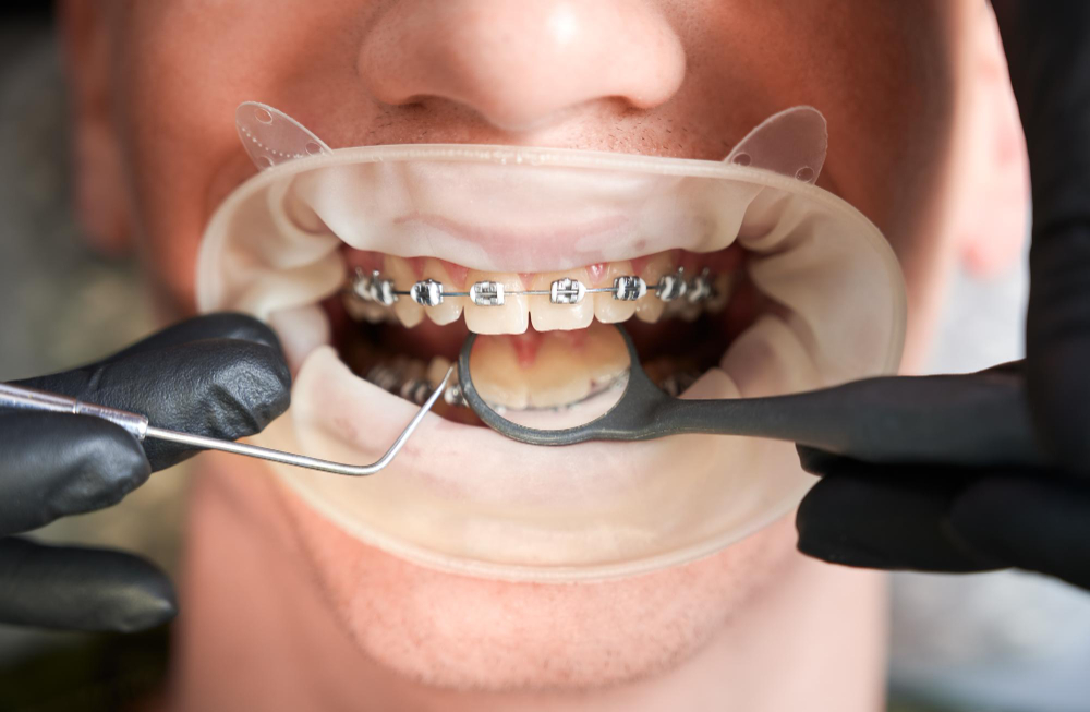 Braces and Aligners in Dahisar West
