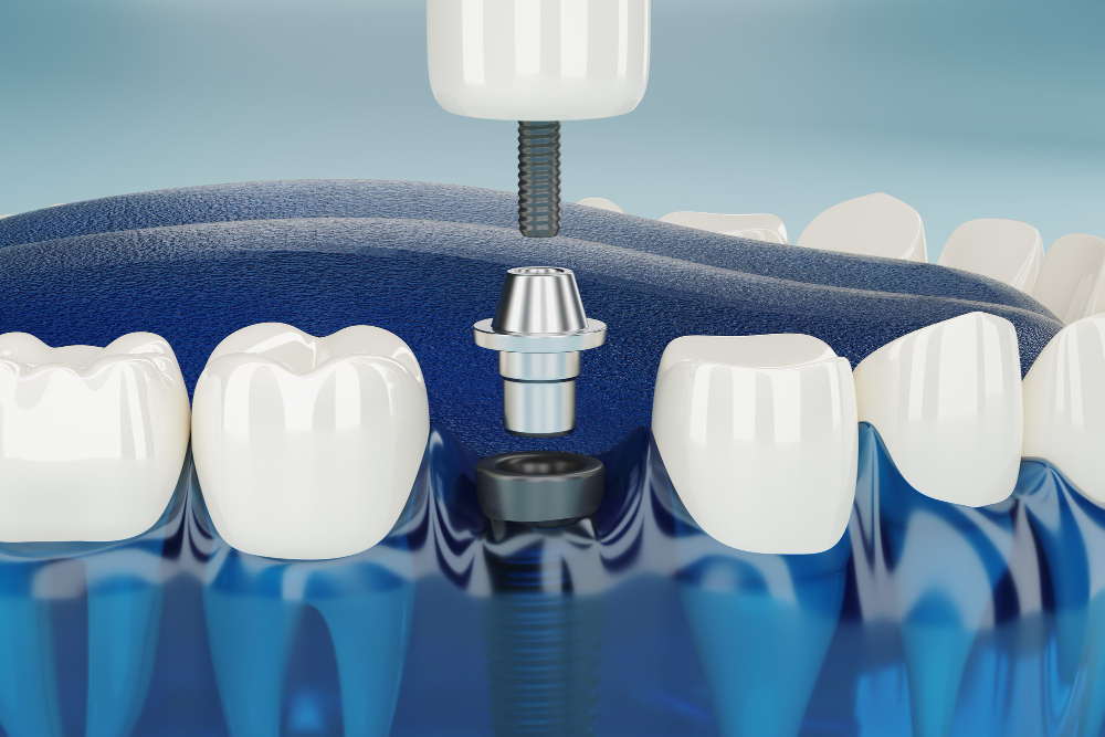 Dental Implant in Dahisar West