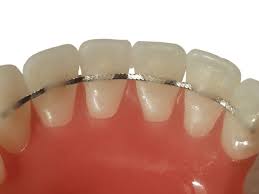 Braces and Aligners in Dahisar West