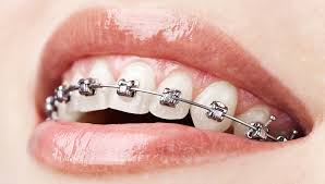 Braces and Aligners in Dahisar West